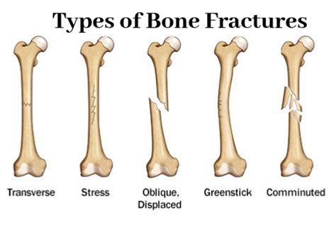 The Different Types Of Bone Fractures Consopharma