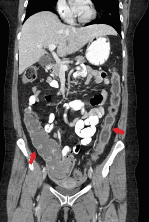 Cureus Refractory Fulminant Colitis Requiring Surgical Intervention