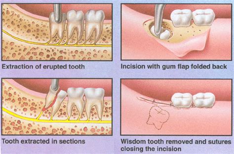 Wisdom Teeth Diagram