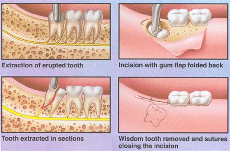 However, it is critical to ask your dentist if these or similar medications are safe for your particular condition. Wisdom Teeth - Pure Dental