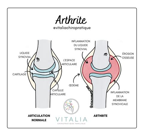 Arthrose Arthrite Ou Rhumatisme