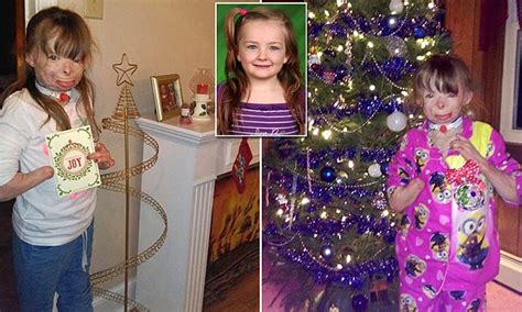 Severely Burned New York Girl Safyre Terry Only Wants Cards For Christmas Daily Mail Online