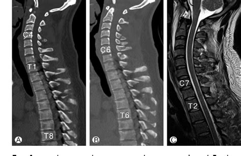 Figure 1 From Twelve Contiguous Spinous Process Fracture Of Cervico