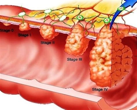 Stages Of Colon Cancer Anatomy System Human Body Anatomy Diagram