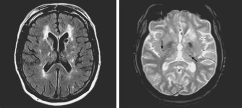 Small Vessel Disease | Radiology Key