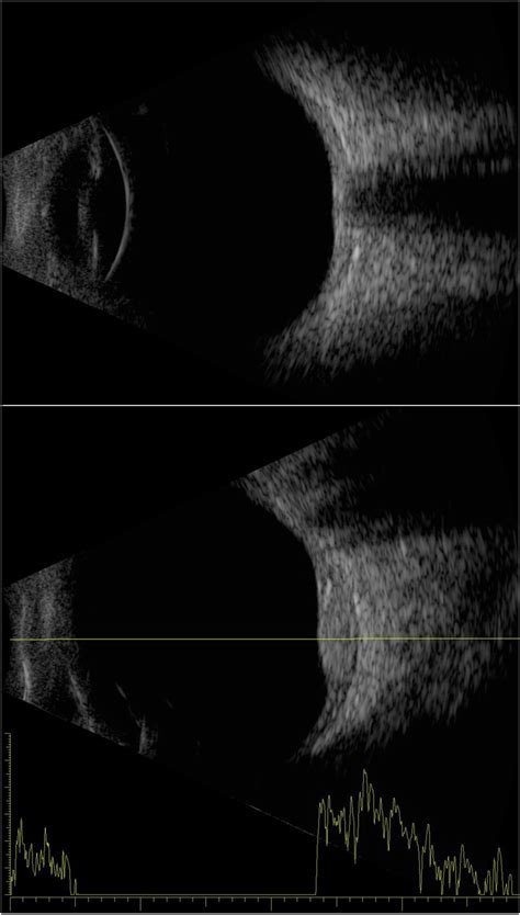Examples Of An Axial B Scan Of A Normal Eye Top And A Combined