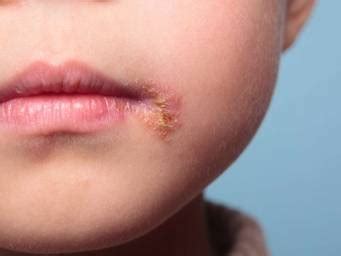 There are two types of herpes infection: Herpes simplex: Symptoms, pictures, types, treatment