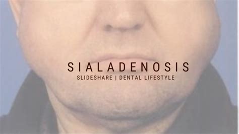 Sialoadenosis Sialosis Oral Health Tips Dental Lifestyle