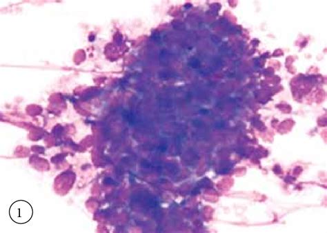 Cytology Smear Showing Metastatic Clusters Of Adenocarcinoma Giemsa