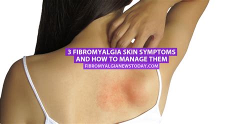 3 Fibromyalgia Skin Symptoms And How To Manage Them Fibromyalgia News Today