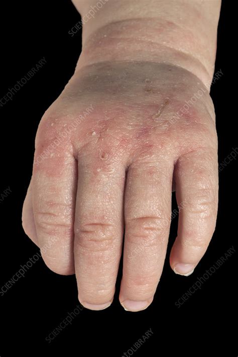 Atopic Eczema On A Babys Hand Stock Image C0389477 Science