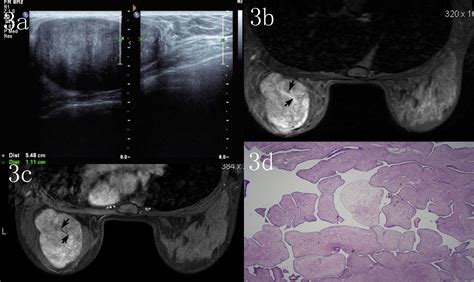 Imaging Findings In Phyllodes Tumors Of The Breast European Journal