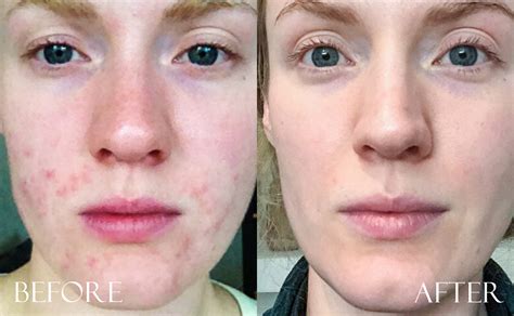 Herbalife skin care before and after. Before & after images Archives - K-beauty Europe