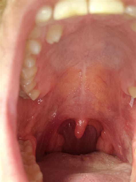 Small Bump Above Tonsil On The Right What Is It Rmedical