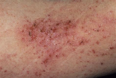Eczema Rash Stock Image M1500236 Science Photo Library