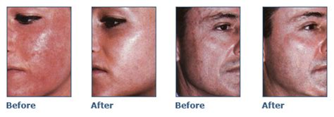 Glycolic Acid Peel Facial Treatment Guilliards Beauty In Banbury A