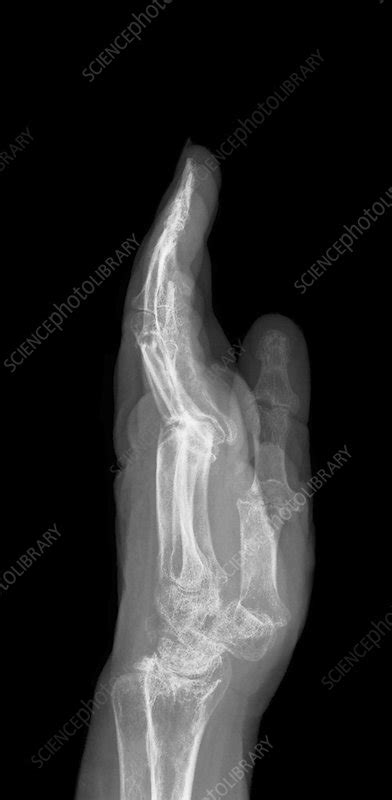 Arthritic Hand X Ray Stock Image C0177171 Science Photo Library