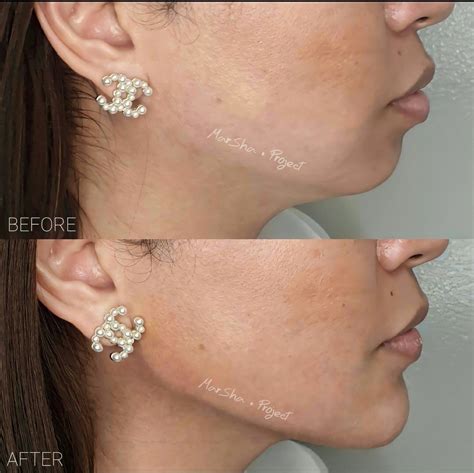 Non Surgical Jawline Sculpting And Contouring In 2022 Cosmetic