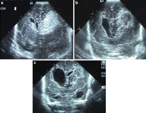 Intraventricular Hemorrhage In The Premature Infant Neupsy Key