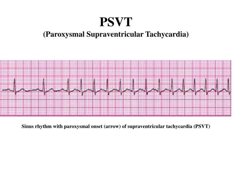 Paroxysmal Supraventricular Tachycardia Heart