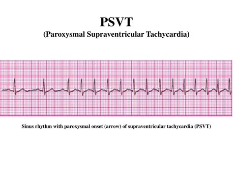 Psvt Ecg Psvt Ecg Supraventricular Tachycardia Svt Acls