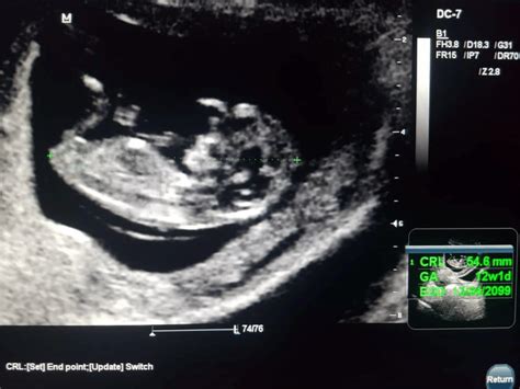 Ultrasound Of Male Fetus At 13 Weeks Download Scientific Diagram
