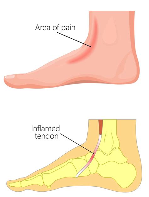 √無料でダウンロード！ My Feet Are Swollen And Painful 242760 My Legs And Feet Are