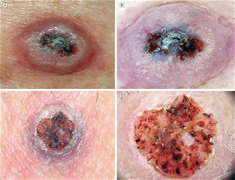 Dermoscopy Of Squamous Cell Carcinoma And Keratoacanthoma Dermatology