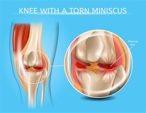 My Knee Hurts When I Bend And Put Pressure On It Injury Health Blog
