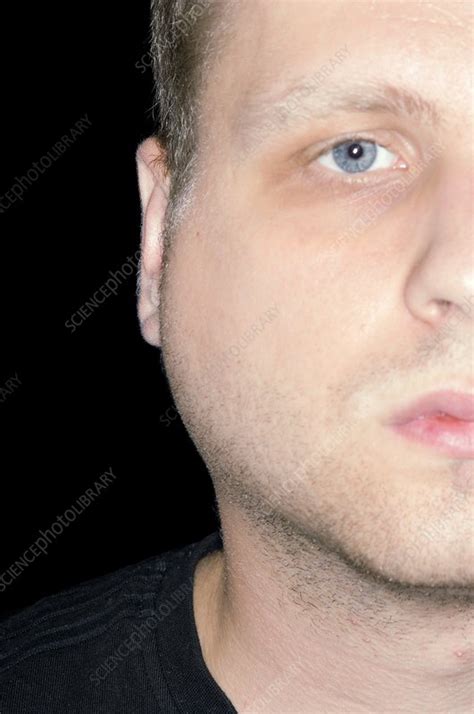 Swollen Gland In Mumps Stock Image C0095261 Science Photo Library