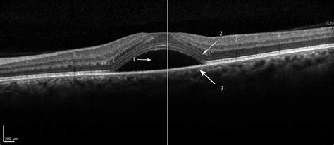 Check spelling or type a new query. The Dilemma of Central Serous Retinopathy, a ...