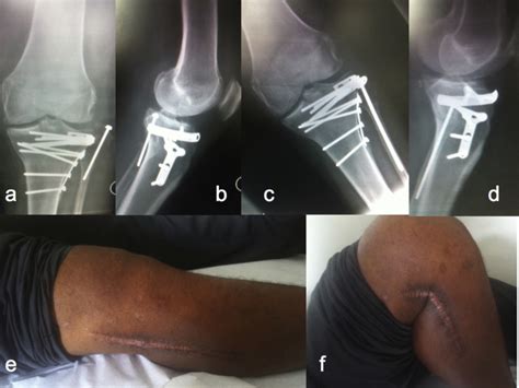 Complications And Outcomes Of The Transfibular Approach For