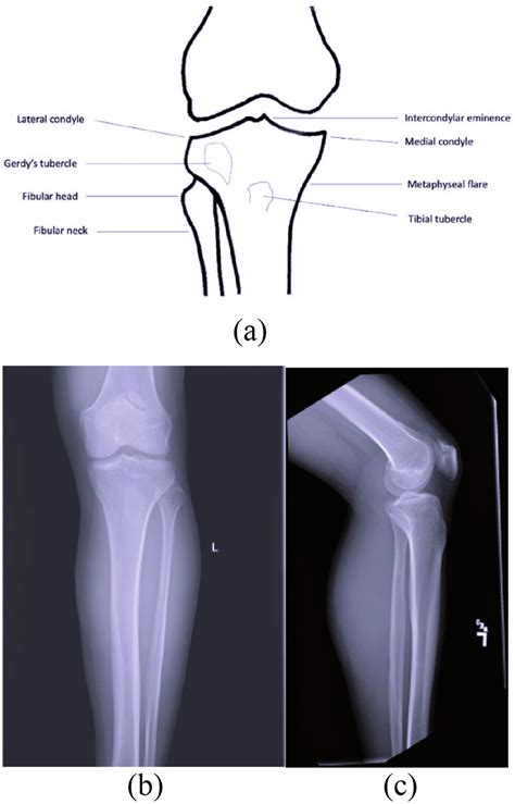 Proximal Tibia Anatomy A And Normal Plain Radiographs Of The Tibial