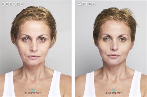 Thread Lift Before And After Images
