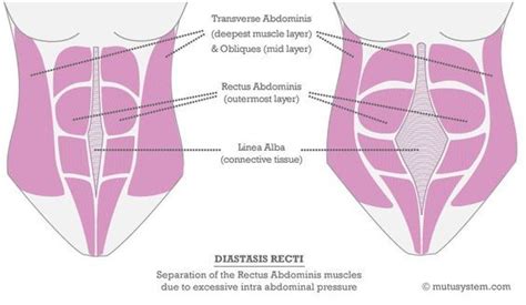 Diastasis Recti Abdominis Exercises And Nutrition To Heal Prenatal