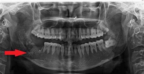 Iatrogenic Fracture Of The Mandibular Angle During Wisdom Tooth Surgery