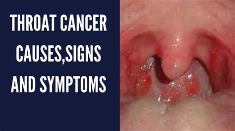 The most common early warning sign of throat cancer is a persistent sore throat. Chest Pressure Sore Throat Nausea Criptiche Tonsille ...