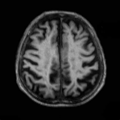 Alzheimer Disease Image