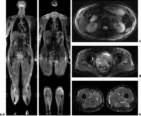 Wb Mri Work Up Of Eosinophilic Fasciitis In A 70 Year Old Woman With