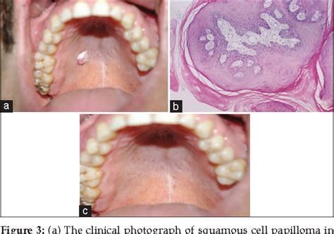 Figure From Verrucous Carcinoma And Squamous Cell Papilloma Of The Oral Cavity Report Of Two