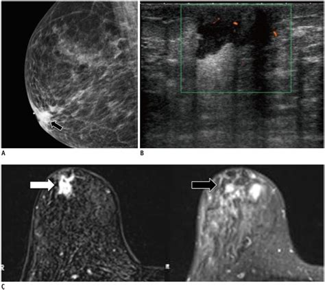 Imaging Features Of Inflammatory Breast Disorders A Pictorial Essay