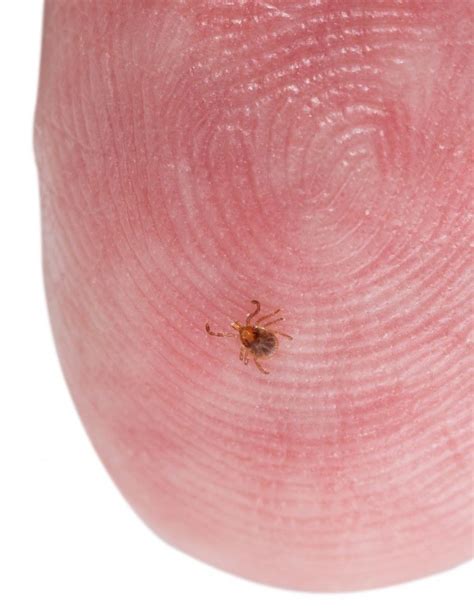 How To Remove Ticks On Humans Ehrlichs Debugged Blog