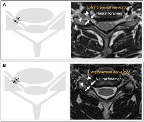 Grading Of Cervical Neural Foraminal Stenosis Cnfs Using T2 Weighted