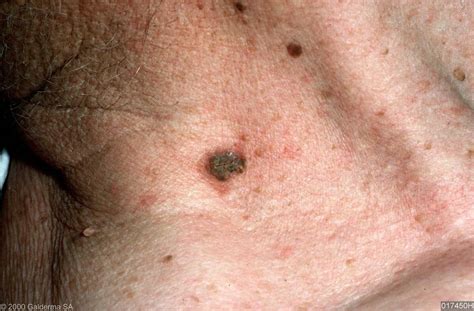 Solar Keratosis Pictures Pictures Photos