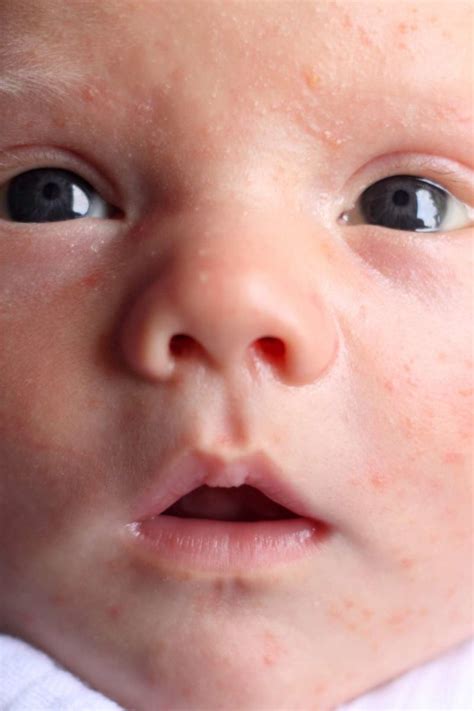 What Causes Skin Rash In Newborn Babies