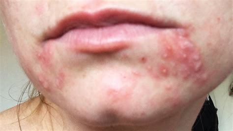 Dealing With Recurring Perioral Dermatitis YouTube
