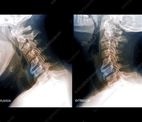 Osteoarthritis Of The Cervical Spine X Rays Stock Image C