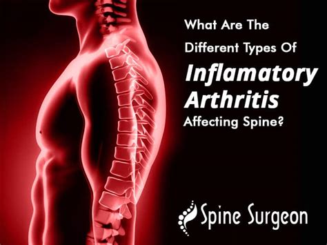 What Are The Different Types Of Inflammatory Arthritis Affecting Spine