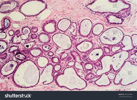 Benign Breast Biopsy Microscopic Image Fibrocystic Stock Photo
