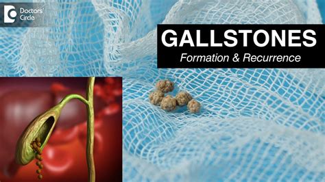Gallbladder Stones Risk Factor Symptoms Do Gallstones Recur Dr